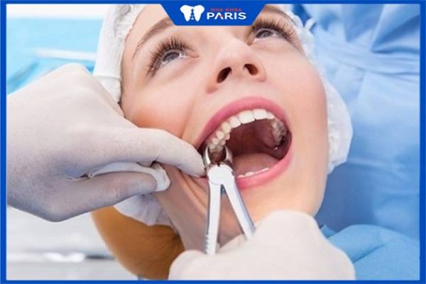 Người bệnh không cần quá lo lắng khi nhổ răng khôn xong hôi miệng