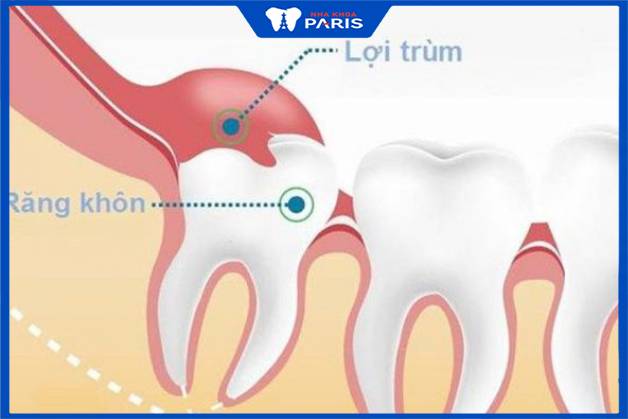 Biến chứng lợi trùm của răng khôn là dạng viêm nhiễm cấp tính của mô mềm bao quanh thân răng
