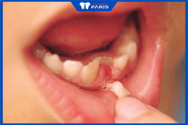 Vai trò của răng sữa tương tự như răng vĩnh viễn