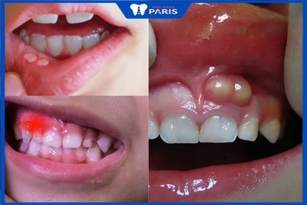 Biến chứng nguy hiểm khi cha mẹ nhổ răng sai cách