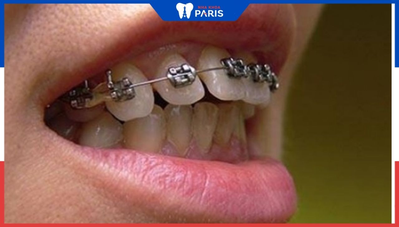 Niềng răng 1 hàm được không – Bác sĩ nha khoa Paris trả lời