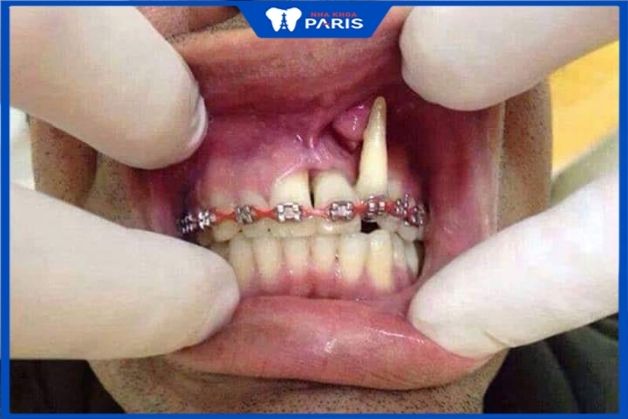 Chết tủy do kỹ thuật niềng răng sai cách niềng răng 1 hàm được không 