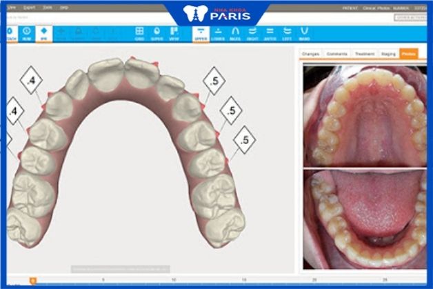 Phần mềm 3D Clincheck hiện đại nhất trong lĩnh vực chỉnh nha niềng răng 1 hàm được không 