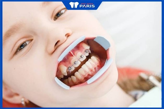 Phương pháp niềng răng cho bé bằng mắc cài kim loại tự đóng