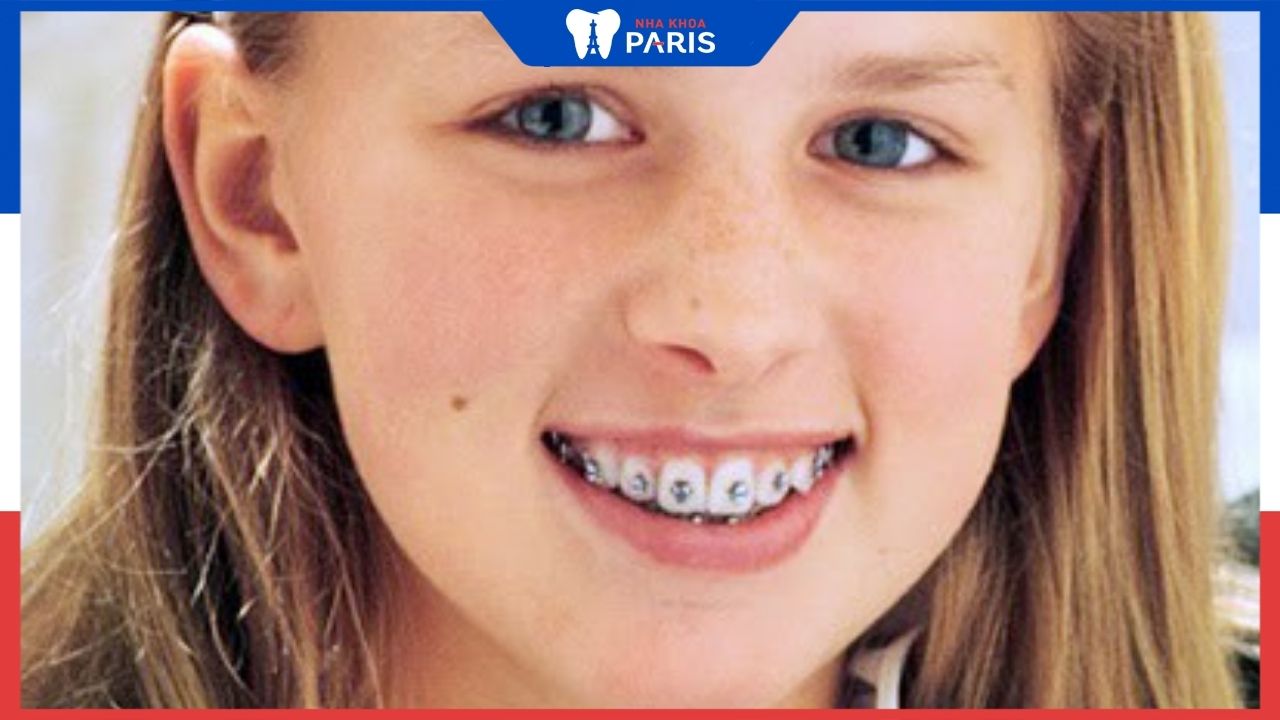 Lý do nên niềng răng cho trẻ vào năm 14 tuổi? phương pháp niềng răng phù hợp