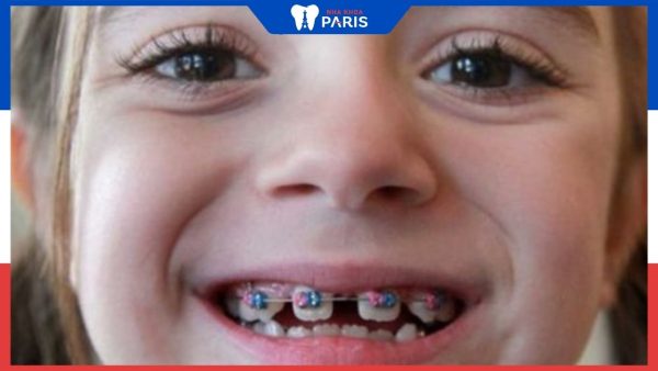 Lưu ý khi niềng răng cho trẻ 6 tuổi tại Nha khoa Paris 