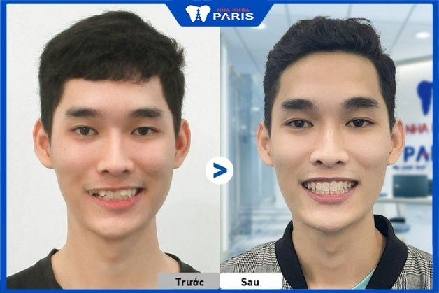 Khách hàng Nguyễn Thanh Hải Niềng răng hô có làm thay đổi khuôn mặt