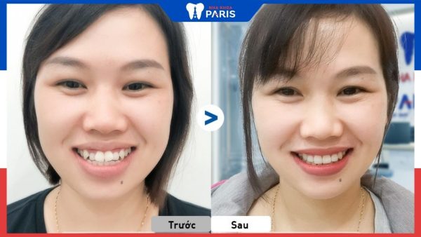 Niềng răng hô có làm thay đổi khuôn mặt? 3 Case thực tế