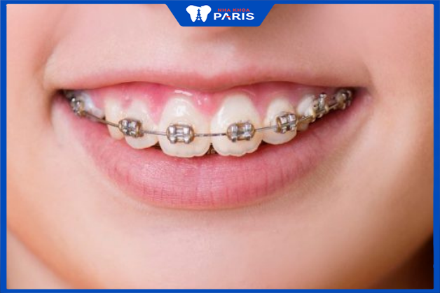 Niềng răng hô mất bao nhiêu thời gian phụ thuộc vào độ tuổi chỉnh nha