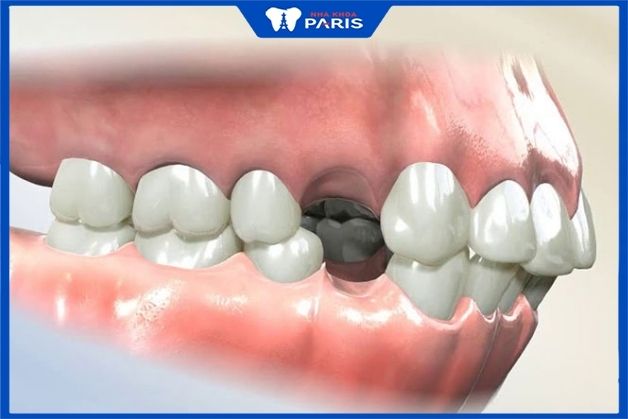 Nhổ răng trước khi niềng răng hô có nguy hiểm không?
