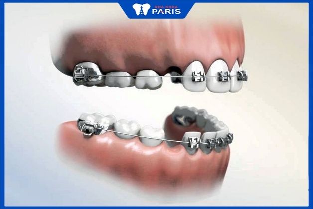 Niềng răng hô nhẹ có phải nhổ răng không còn phụ thuộc vào độ khít của răng