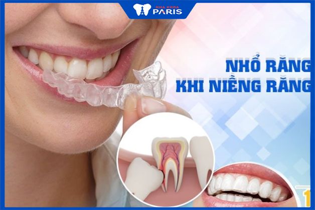Niềng răng invisalign có nhổ răng không là thắc mắc của nhiều người