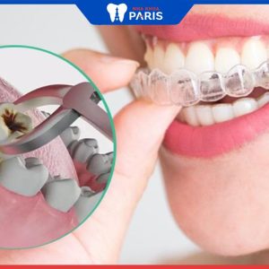 Niềng răng Invisalign có phải nhổ không? Bác sĩ giải đáp