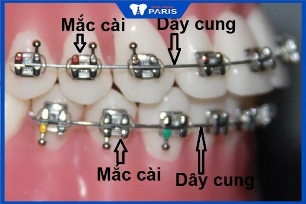 Niềng răng mắc cài kim loại là kỹ thuật chỉnh nha xuất hiện đầu tiên