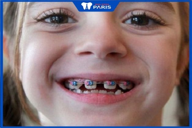 Niềng răng kim loại có thun nha khoa bắt mắt Niềng răng mắc cài kim loại thường