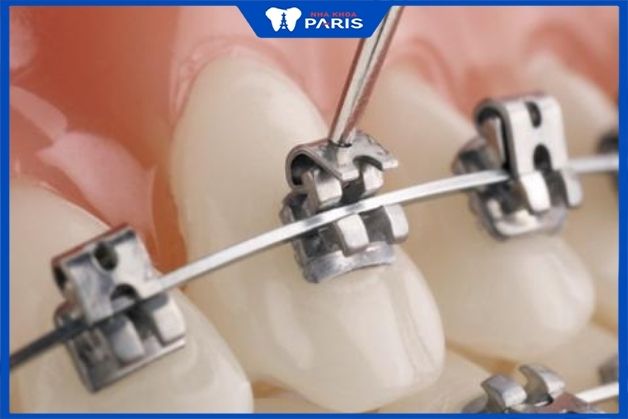 Tìm hiểu phương pháp niềng răng mắc cài kim loại tự đóng