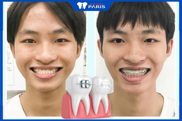 Case niềng răng móm hàm tại Nha khoa Paris