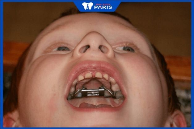 Niềng răng khí cụ tháo lắp cho trẻ dưới 11 tuổi