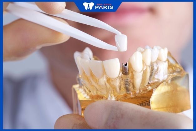 Phục hình răng sứ trên implant được hiểu là gì