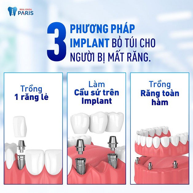 Phương pháp trồng răng giả bằng implant