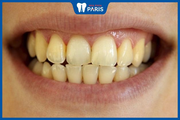 Răng bị ố vàng do thường xuyên ăn thực phẩm sẫm màu