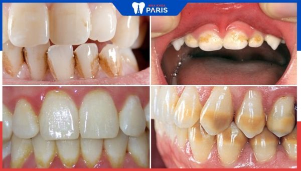 10 Nguyên nhân Răng bị ố vàng: Bí quyết loại bỏ ố vàng