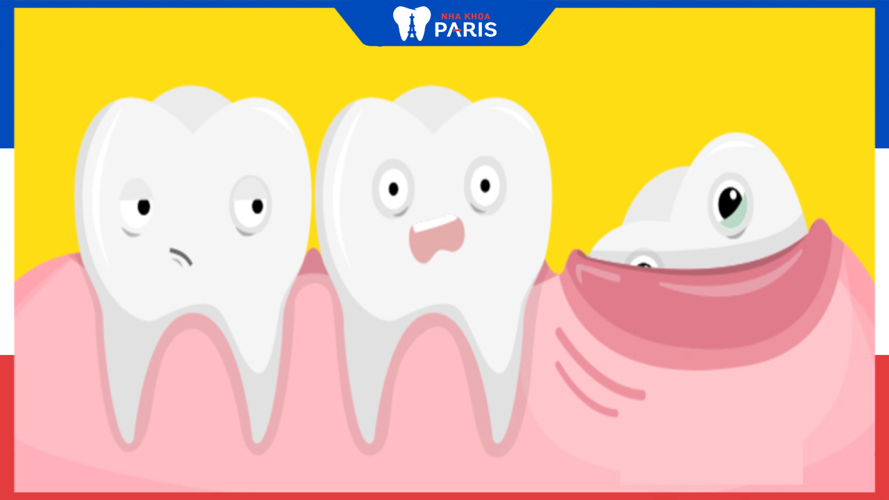 Răng khôn mọc thẳng có nên nhổ không và nhổ có đau không?