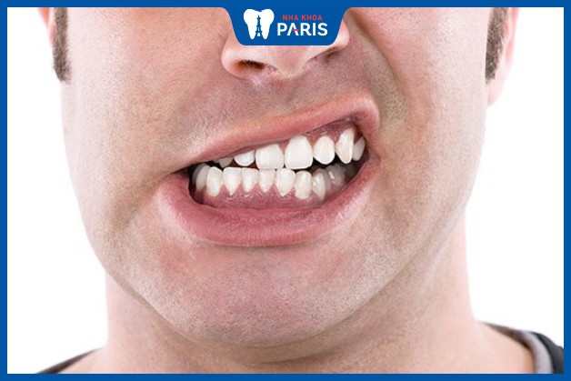 Thói quen nghiến răng có thể gây hại cho răng
