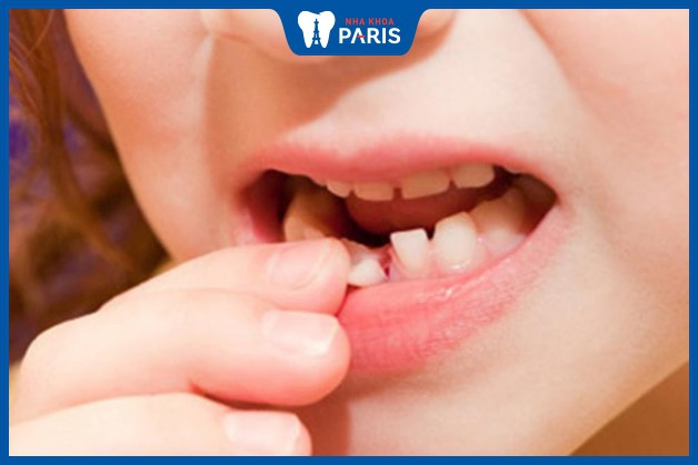 Răng sữa lung lay có thể là dấu hiệu cho thấy trẻ chuẩn bị thay răng