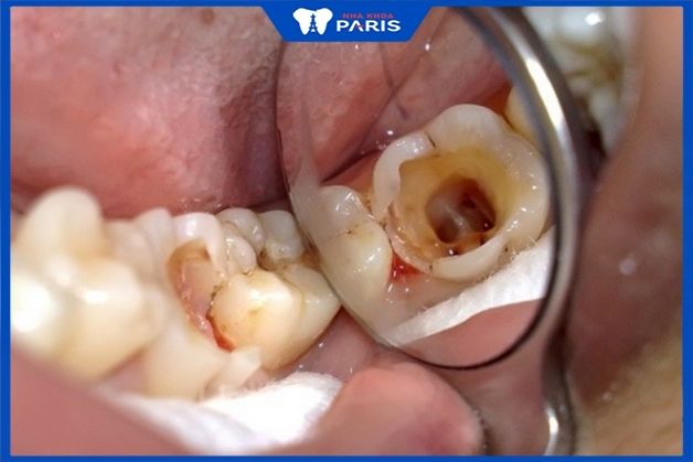 Tìm hiểu: răng sâu bị vỡ có bọc sứ được không?