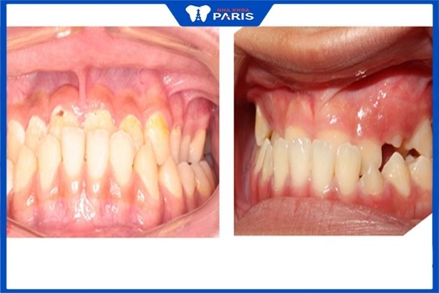 Tình trạng răng bị lệch khớp cắn mức độ nặng không phù hợp bọc sứ