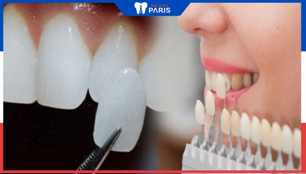 Review: Bọc răng sứ có bị đau không? Giữ được mấy năm?