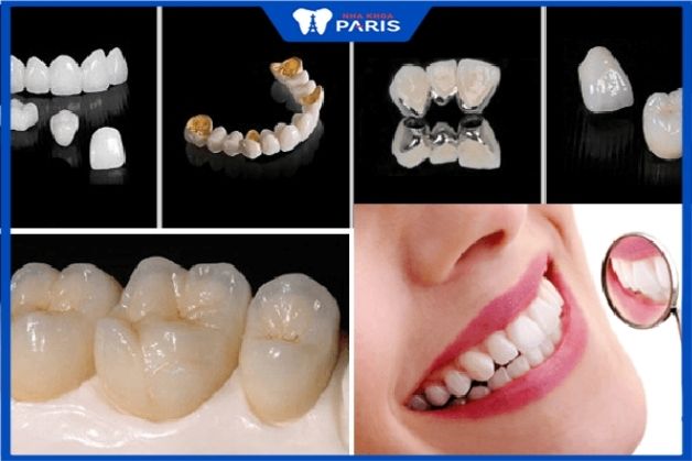 Các loại răng sứ hiện nay