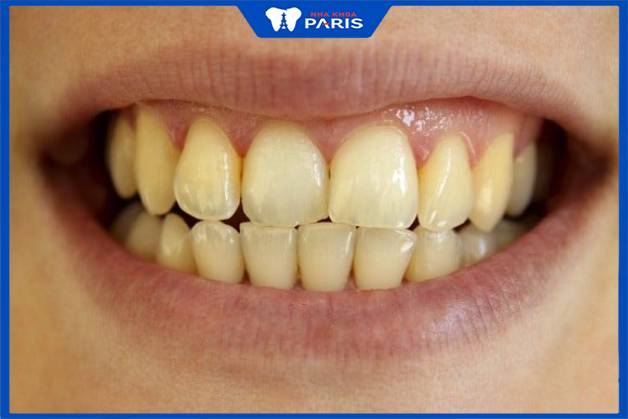 Người có răng ố vàng do tác nhân bên ngoài có thể tẩy bằng máng