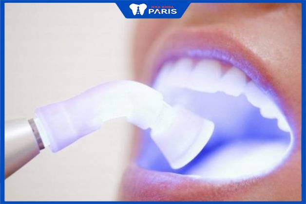 Làm trắng răng không gây đau đớn
