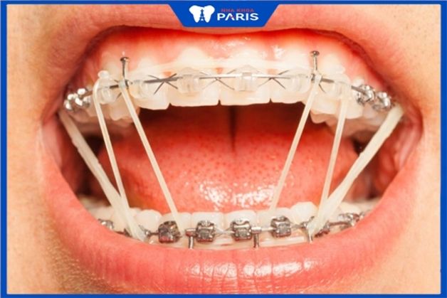 Thun liên hàm giúp rút ngắn thời gian niềng răng Thời gian niềng răng nhanh nhất là bao lâu