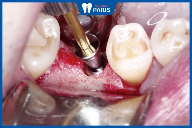Trồng răng mất nhiều máu và cần sức khỏe ổn định 