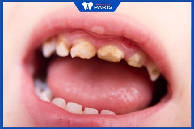 Biểu hiện sâu răng ở bé 5 tuổi