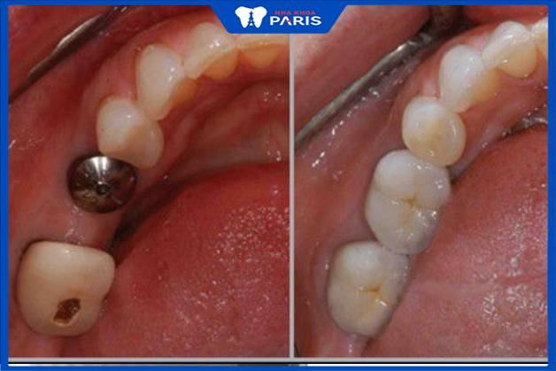 Nên đặt trụ implant ngay sau khi nhổ răng
