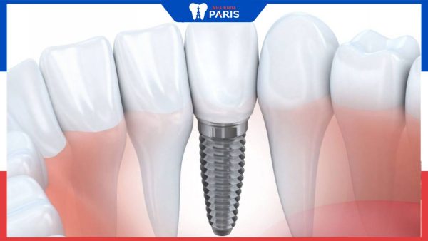 Trồng răng Implant bao lâu thì lành? Cách rút ngắn thời gian