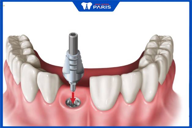 Trồng răng giả implant có đau không trong suốt quá trình phẫu thuật