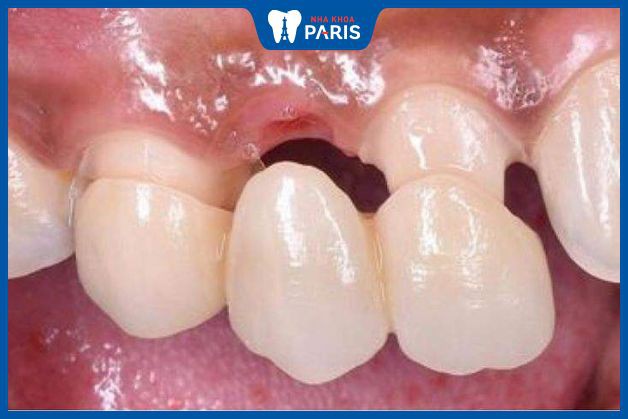 Cầu răng sứ mang nhiều ưu điểm hơn hàm tháo lắp