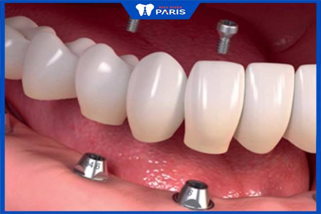 Trồng răng giả có đau không phụ thuộc vào số lượng implant cấy ghép