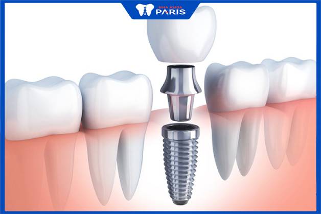 Trồng implant là kỹ thuật phục hình răng mất hiện đại nhất ngày nay
