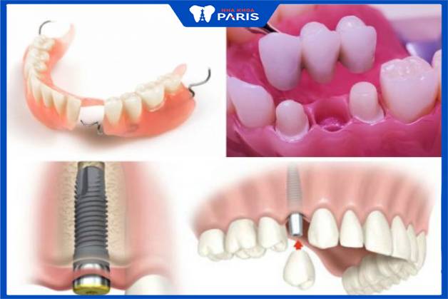 Trồng răng giả mất thời gian bao lâu phụ thuộc vào phương pháp thực hiện