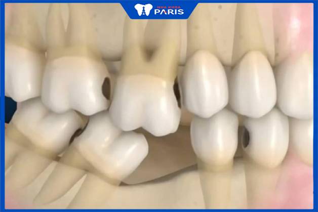 Mất răng sau một thời gian không được phục hình sẽ bị tiêu xương hàm