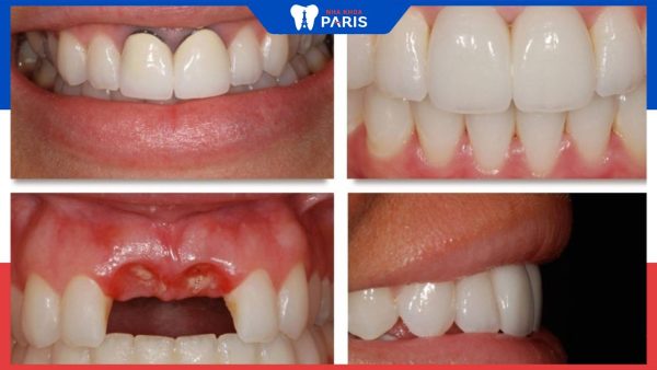 Trồng răng giả mất thời gian bao lâu: Những yếu tố ảnh hưởng