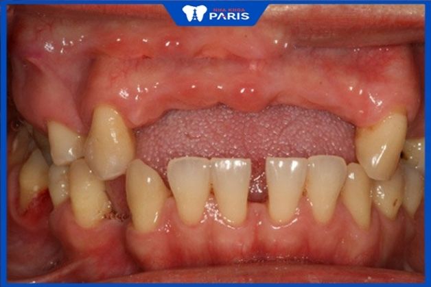 Trồng răng giả khi bị mất răng