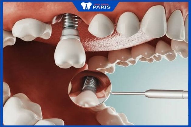 Trong quá trình trồng răng implant khách hàng thấy không đau,
