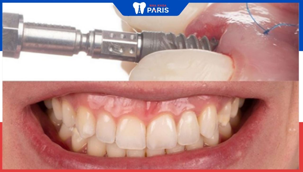 Trồng răng implant có đau không – 6 cách giảm đau nhanh